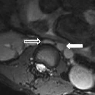 30° left tilt, larger IVC. Solid arrow, aorta. Modified from cited article.