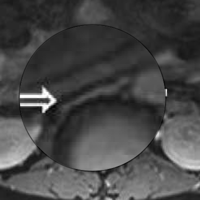 Zoomed in on compressed IVC while supine. Gee, it’s smushed. Modified from original