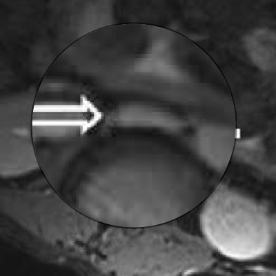 Zoomed in on larger IVC, 30° left tilt. Modified from cited article.
