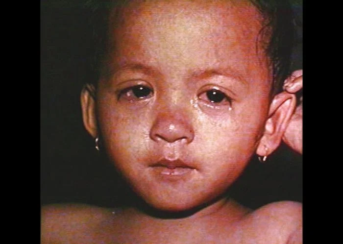 Image 1, Measles rash on face, conjunctivitis, mild coryza. From CDC .