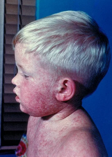 Image 3: Measles rash on face, spreading downward. From CDC .