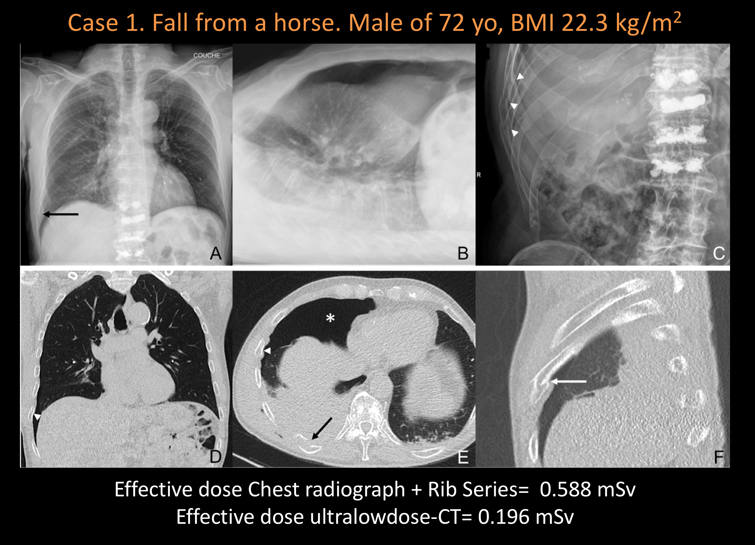 Ultralow Dose Ct Chest Cxr Radiation Dose Journalfeed