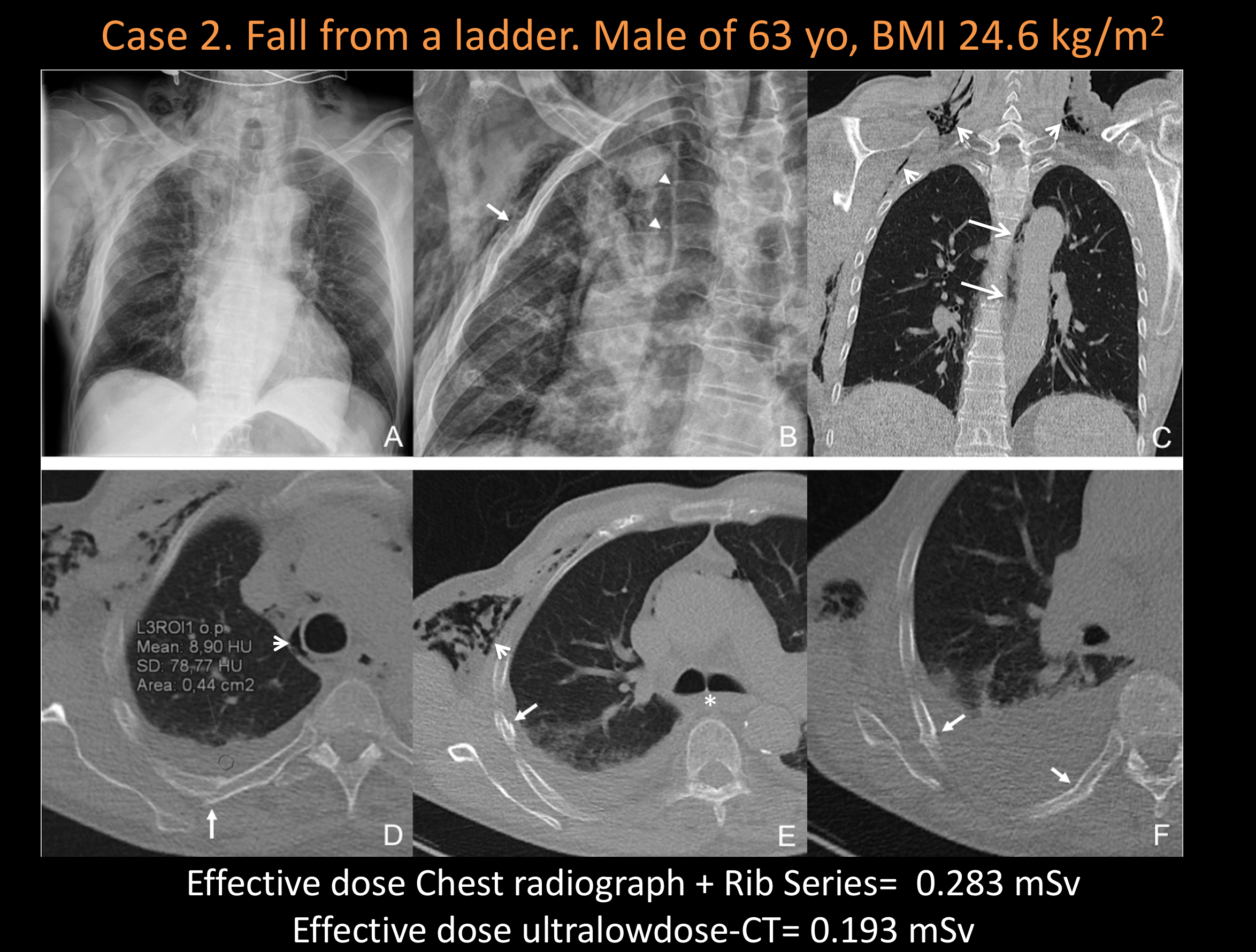 From cited article. “Chest radiographs AP view (A) and rib series (B). AP view demonstrates extensive subcutaneous emphysema and pneumomediastium (A). Fracture of the 3rd and 4th ribs were better visualized on rib series view (arrow) as well as pneumomediastinum (arrowheads) (B). Ultralowdose-CT (C, D, E, and F) enables in-depth assessment with a single acquisition. Coronal view demonstrates para-aortic pneumomediastinum (arrows) and subcutaneous emphysema (arrowheads) (C). Magnified axial plane showing 4th rib posterior aspect fracture (arrow) and pneumomediastinum (arrowhead) is also well imaged (D). Note the small circle region circle region of interest within the pleural effusion demonstrating that no hemorrhagic component is within (mean 8.9 HU). Such evaluation would not be feasible on a simple radiograph. Axial plane demonstrating 4th rib lateral aspect fracture (arrow), subcutaneous emphysema (arrowhead), and tracheal bifurcation fluid accumulation (asterisk) (E). Axial oblique plane obtained with multiplanar reconstruction demonstrating a bifocal fracture (arrows) of the 5th rib, not detected on the chest radiograph (F). The radiographic work-up delivered 46.6% radiation dose more than ultralowdose-CT.”