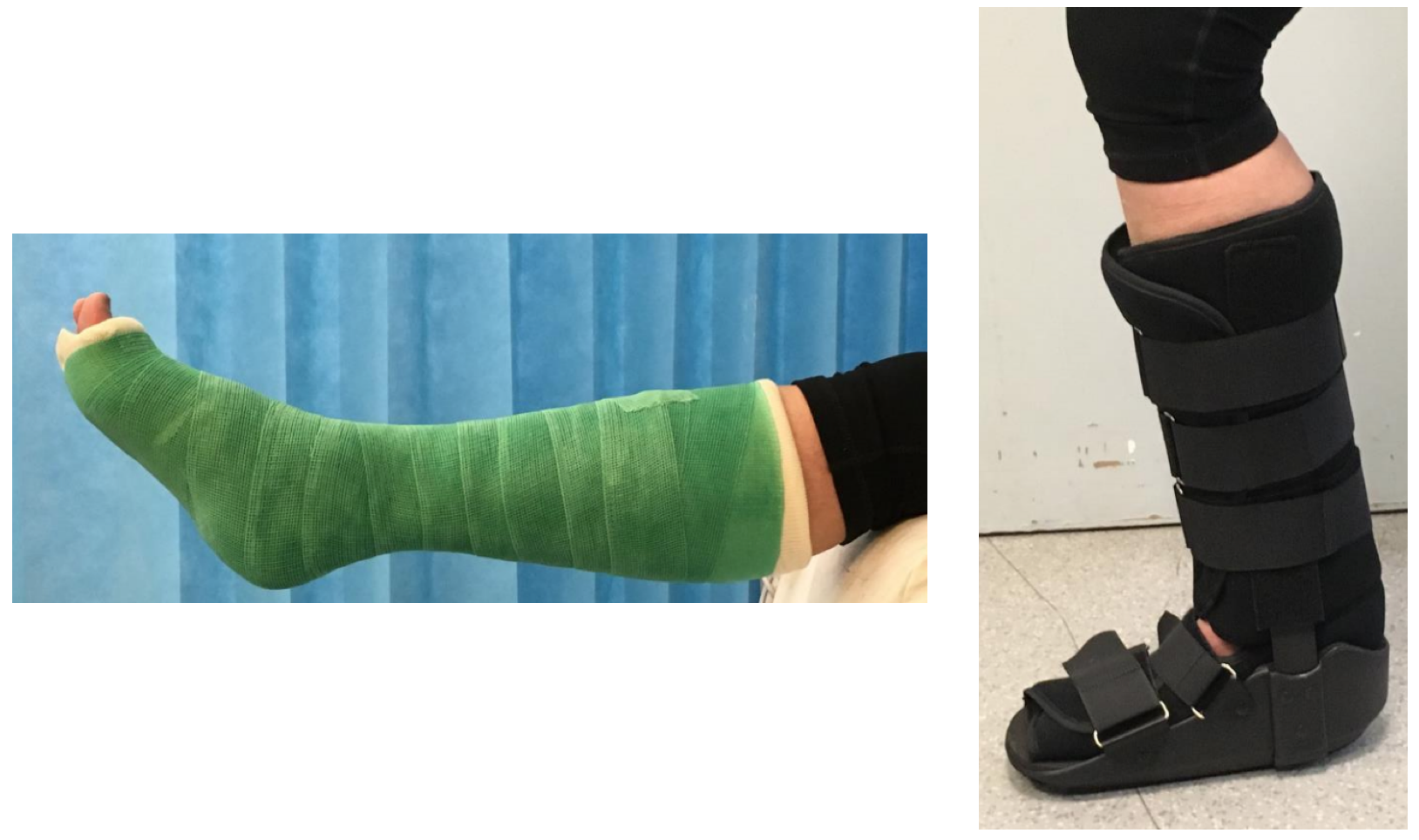 Cast or Walking Boot for Achilles Tendon Rupture? — JournalFeed