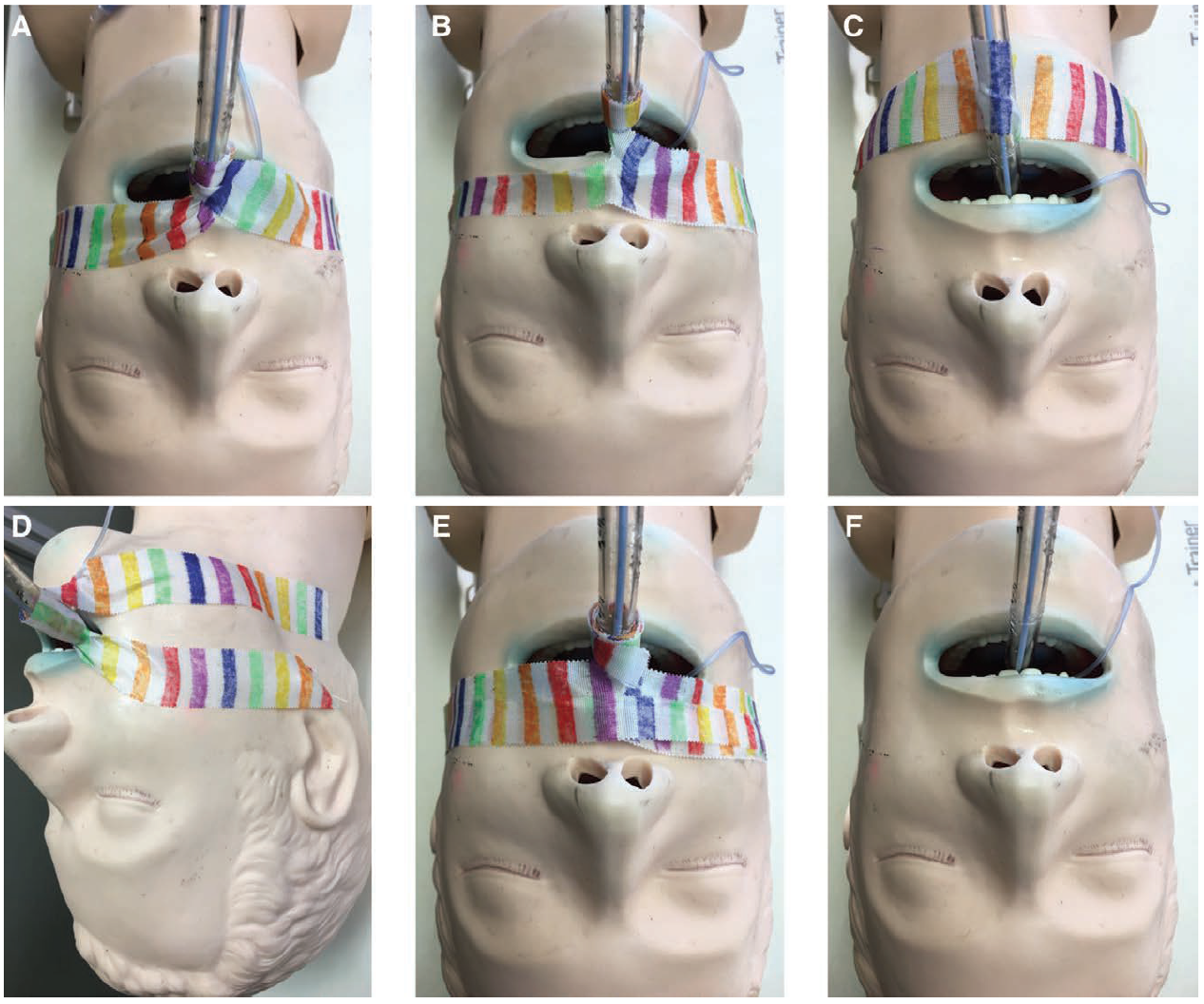 How to Tape an ETT That Won't Come Out — JournalFeed