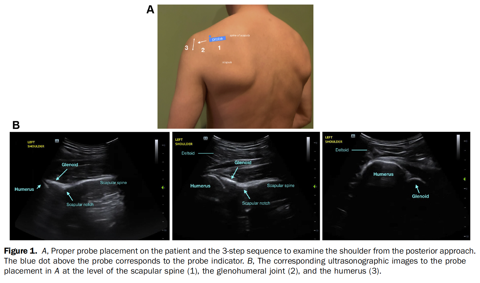 MSK Ultrasound for Shoulder Dislocation — JournalFeed