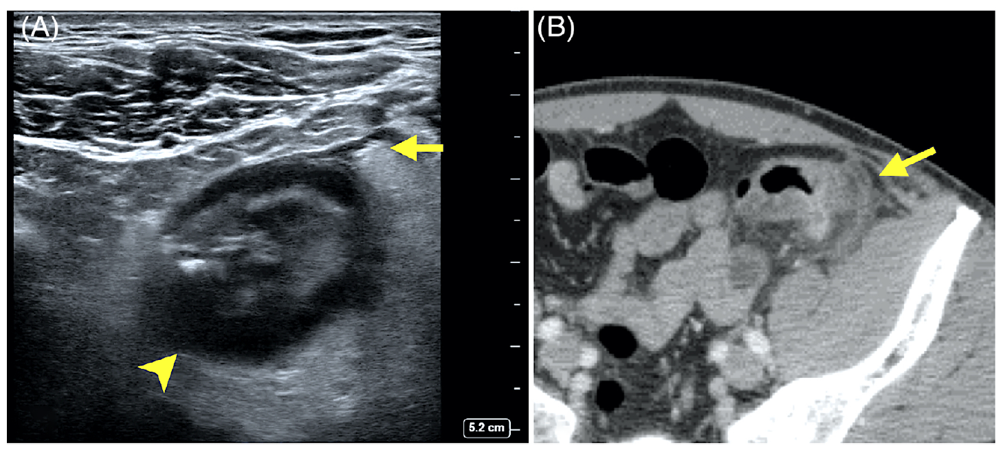 From cited article, comments by Drew Clare: Two examples of acute diverticulitis on POCUS. On the left, a transverse ultrasound image of sigmoid colon in patient with acute diverticulitis demonstrates thickened colonic wall (arrowhead) giving it the pseudokidney appearance. The image on the left also demonstrates outpouching of colonic contents through the wall of the colon and echogenic foci (arrow). The corresponding CT image on the right has adjacent air in a diverticulum (arrow).