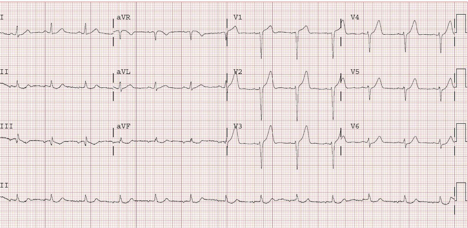 This is from Dr. Smith’s ECG blog and is not the ECG from the cited article, though it illustrates the same point. This tracing is a 46 year old with chest pain. It does not have R-wave regression, but it does have poor R wave progression. Click image for source link.