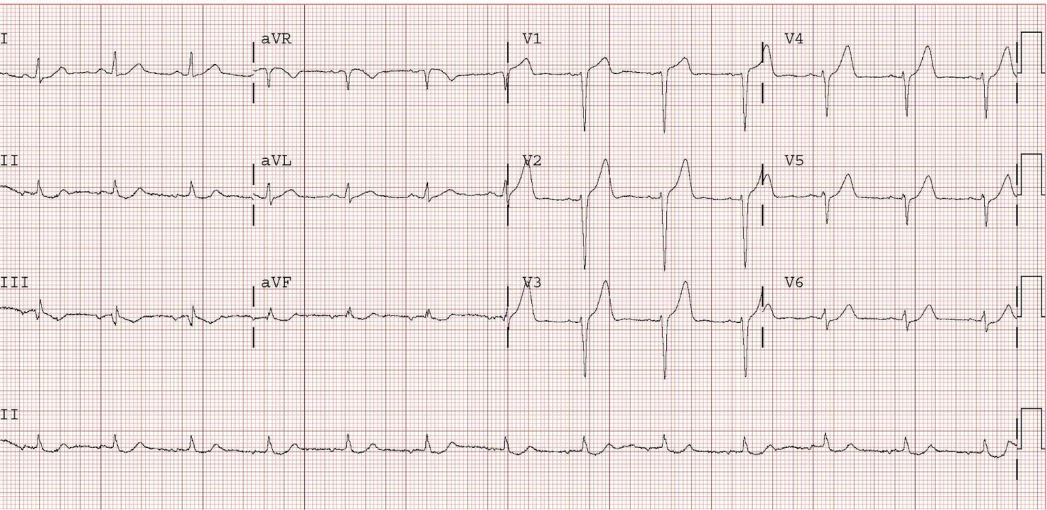 This is from Dr. Smith’s ECG blog and is not the ECG from the cited article, though it illustrates the same point. This tracing is a 46 year old with chest pain. It does not have R-wave regression, but it does have poor R wave progression. Click image for source link.