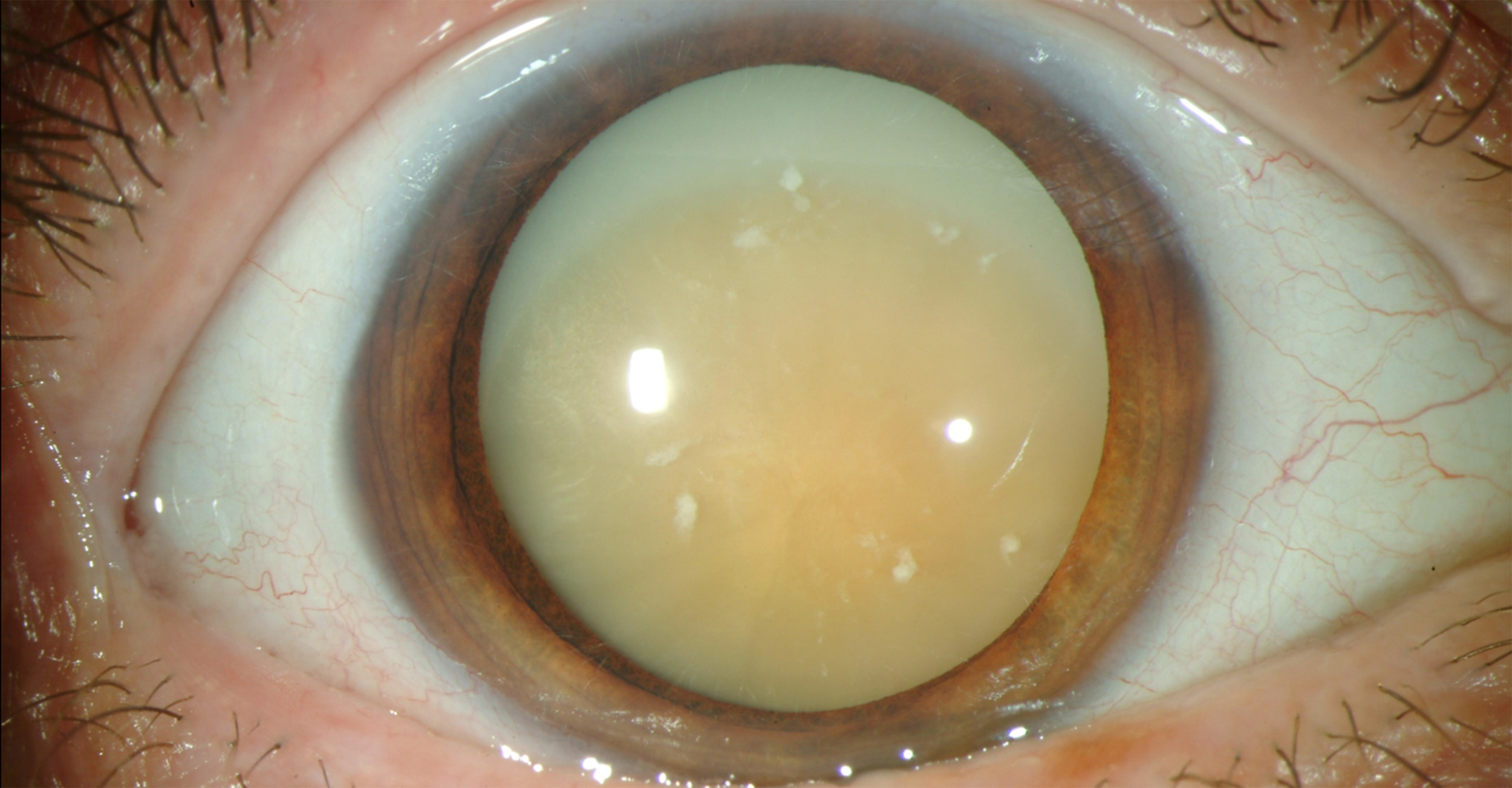 In developed countries, almost no one goes blind from cataract.