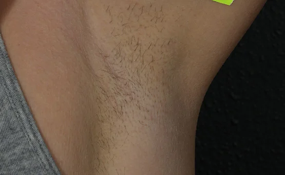 BeforeArmpit.jpg