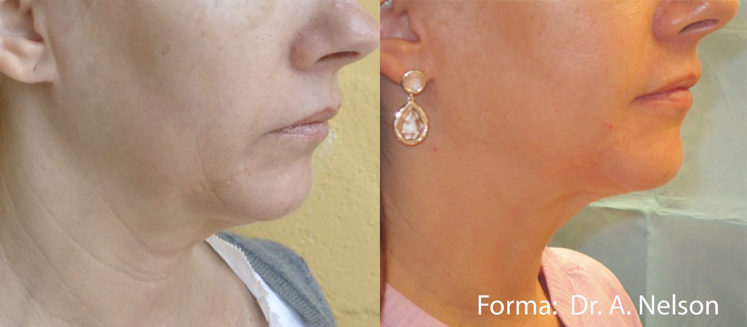 forma-before-after-dr-a-nelson-preview-2.jpg
