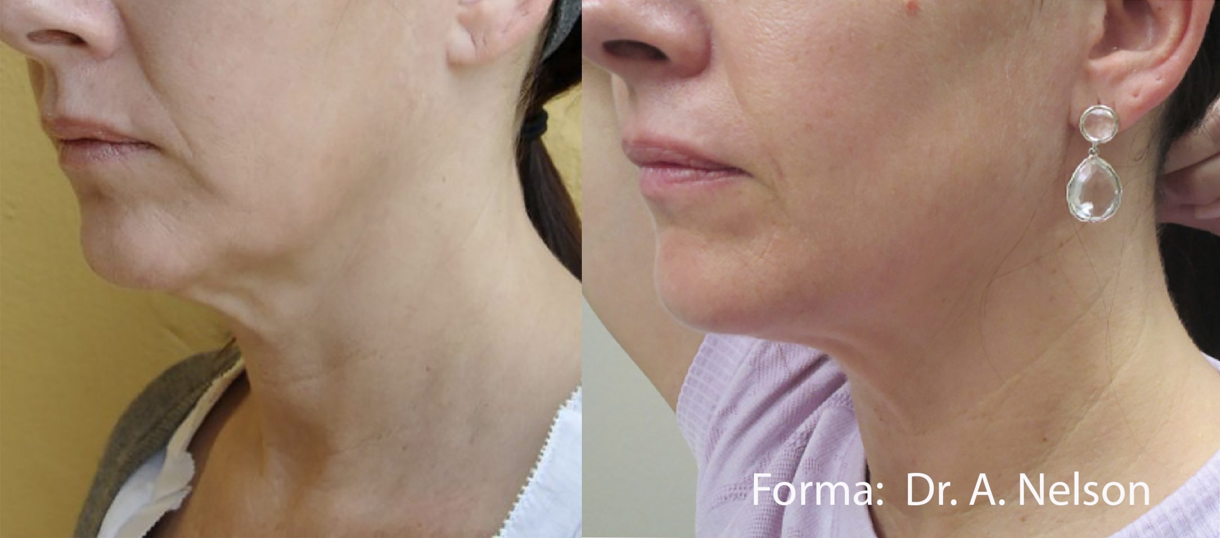 forma-before-after-dr-a-nelson-preview-1.jpg