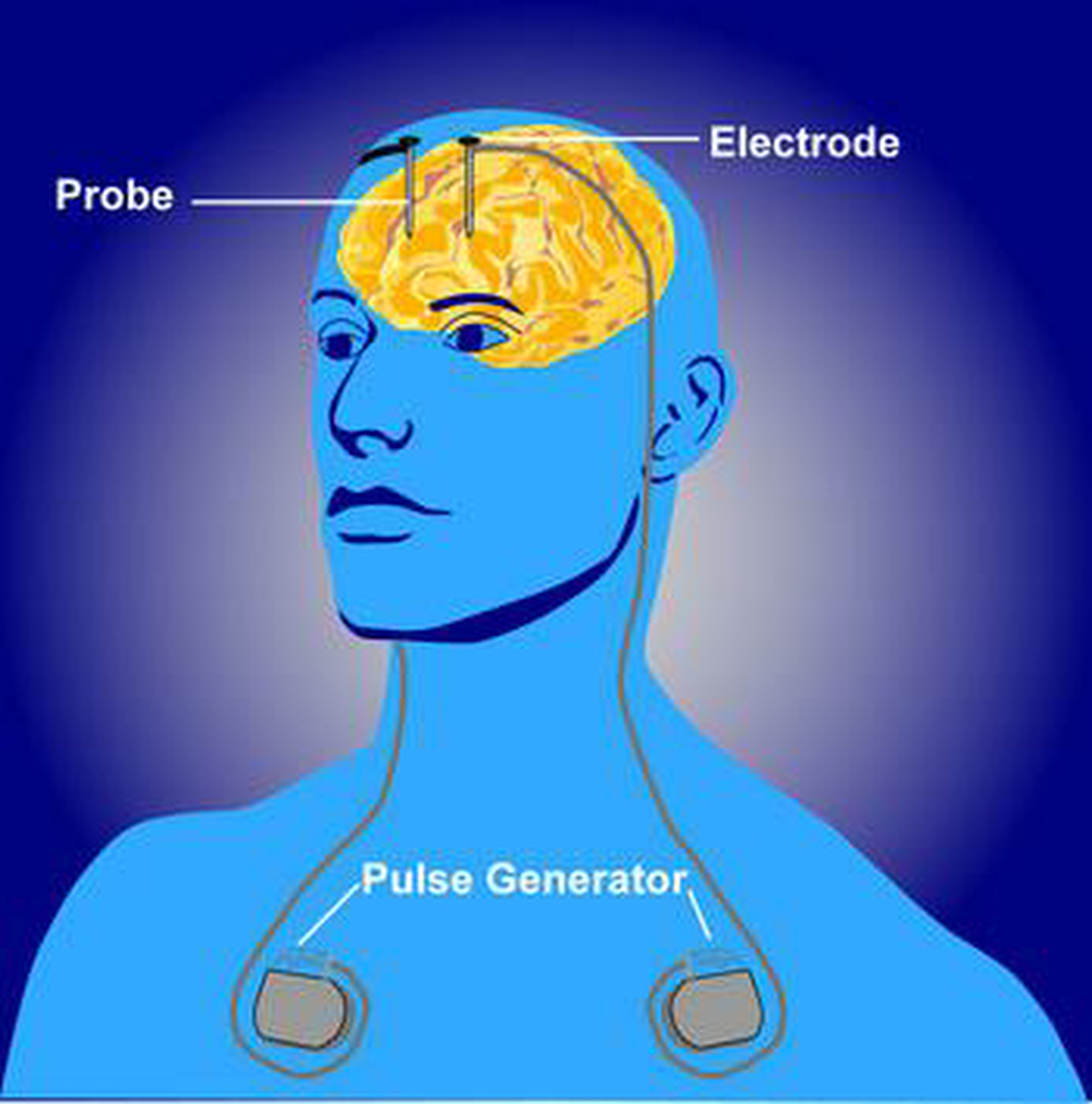 Brain Stimulation Therapies — THE POWER TO HEAL® (323) 6805411