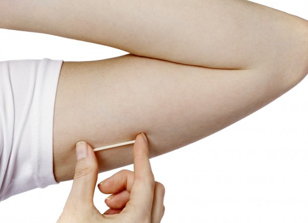 Nexplanon implant size and placement. PHOTO CREDIT: dxline.info 