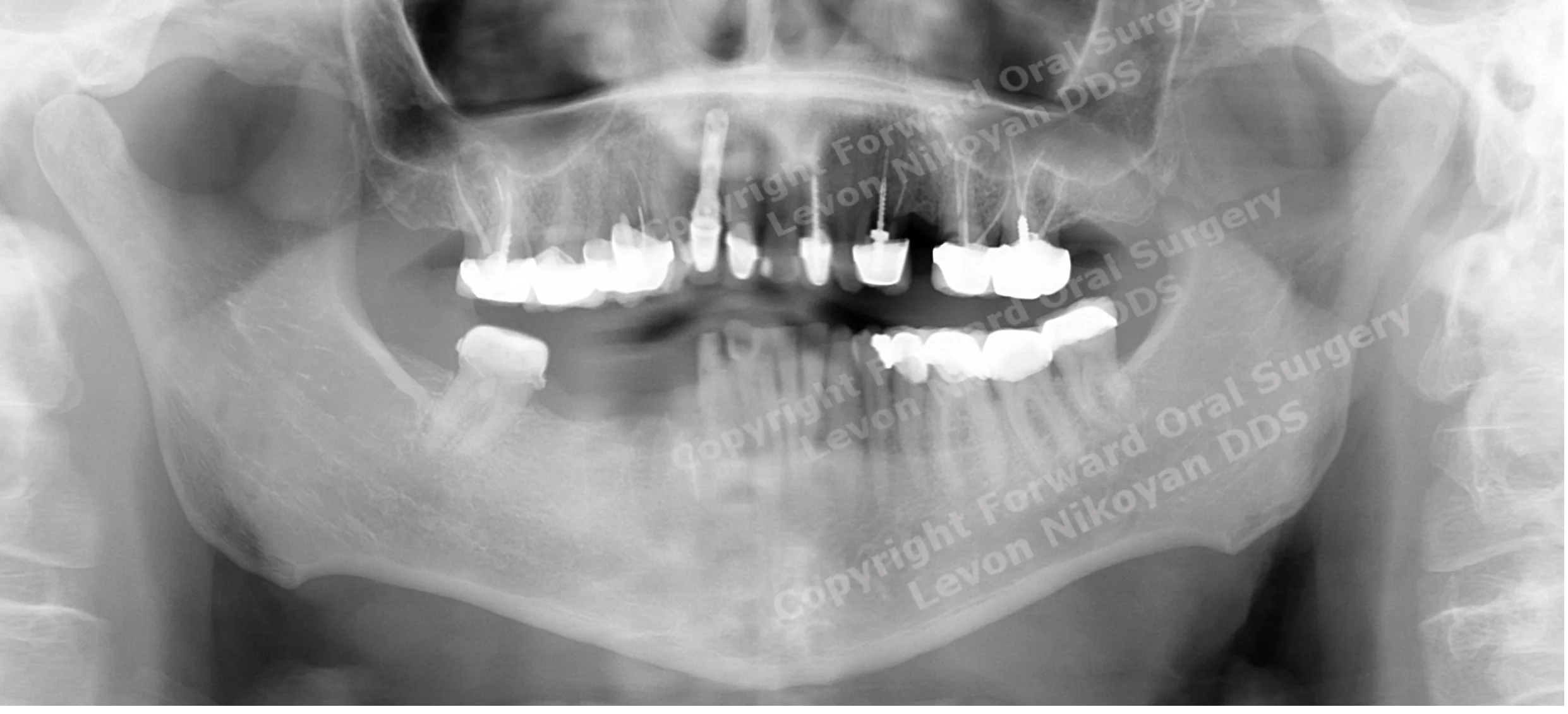 Forward Oral Surgery