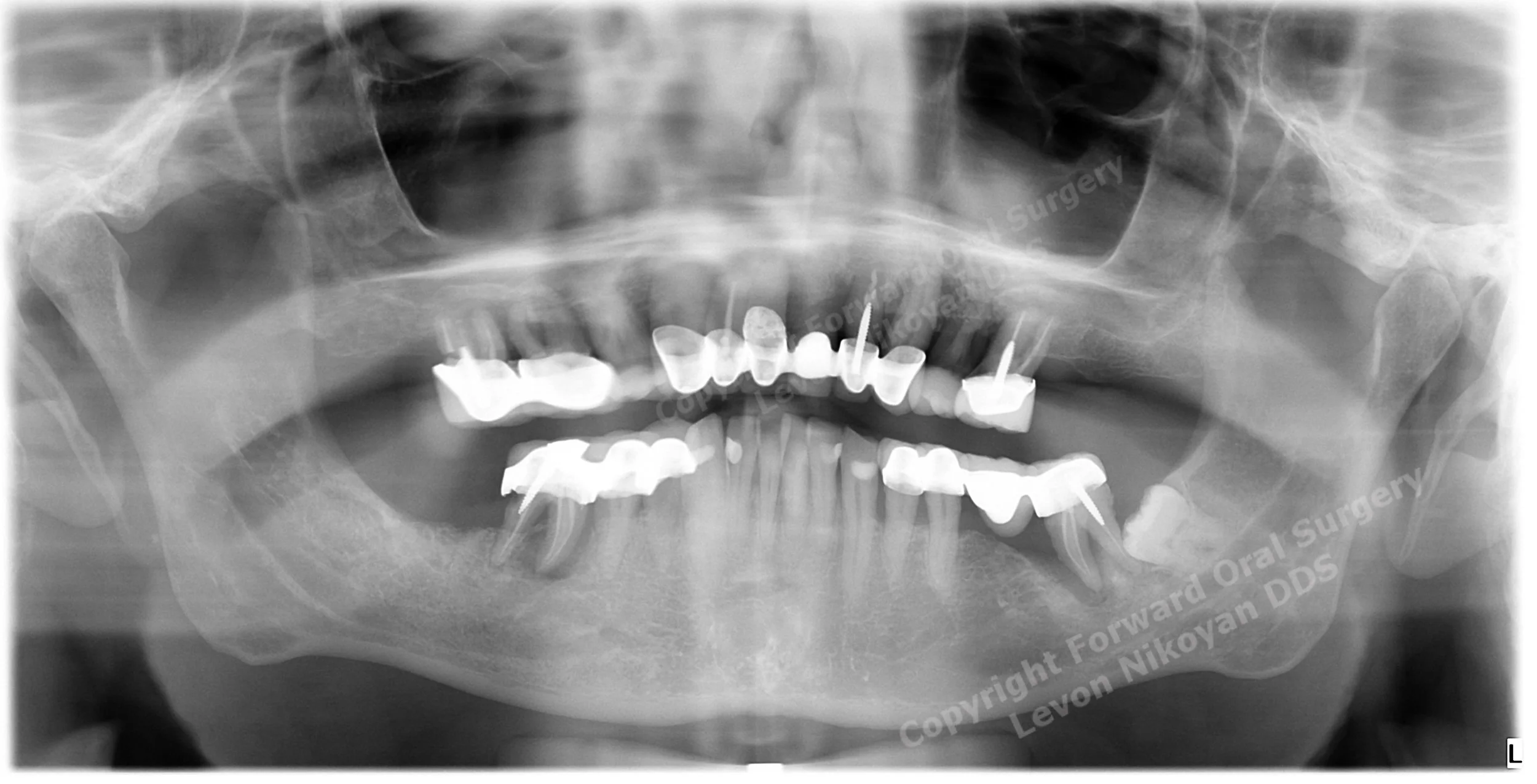 Forward Oral Surgery