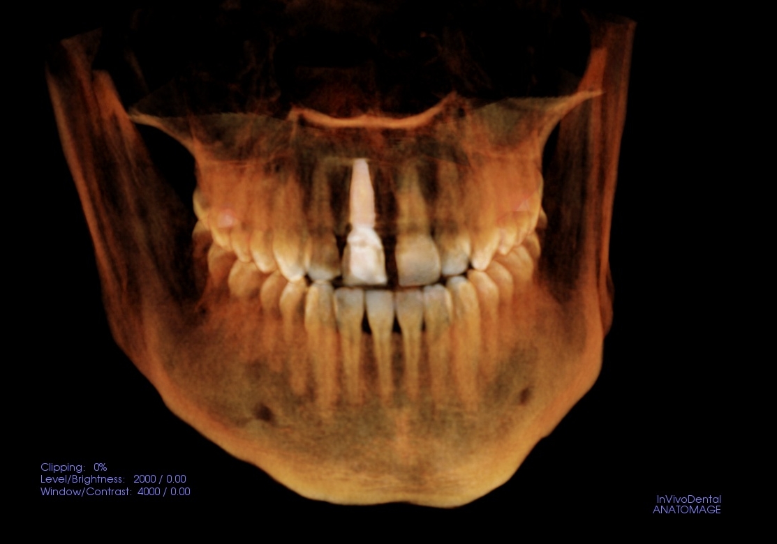 Immediate Dental implant, with immediate temporary. Patient left without the decayed tooth, with an implant and a great looking temporary.