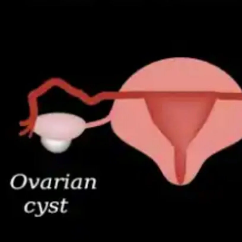 Ovarian, Breast and Armpit Cysts Anyone??