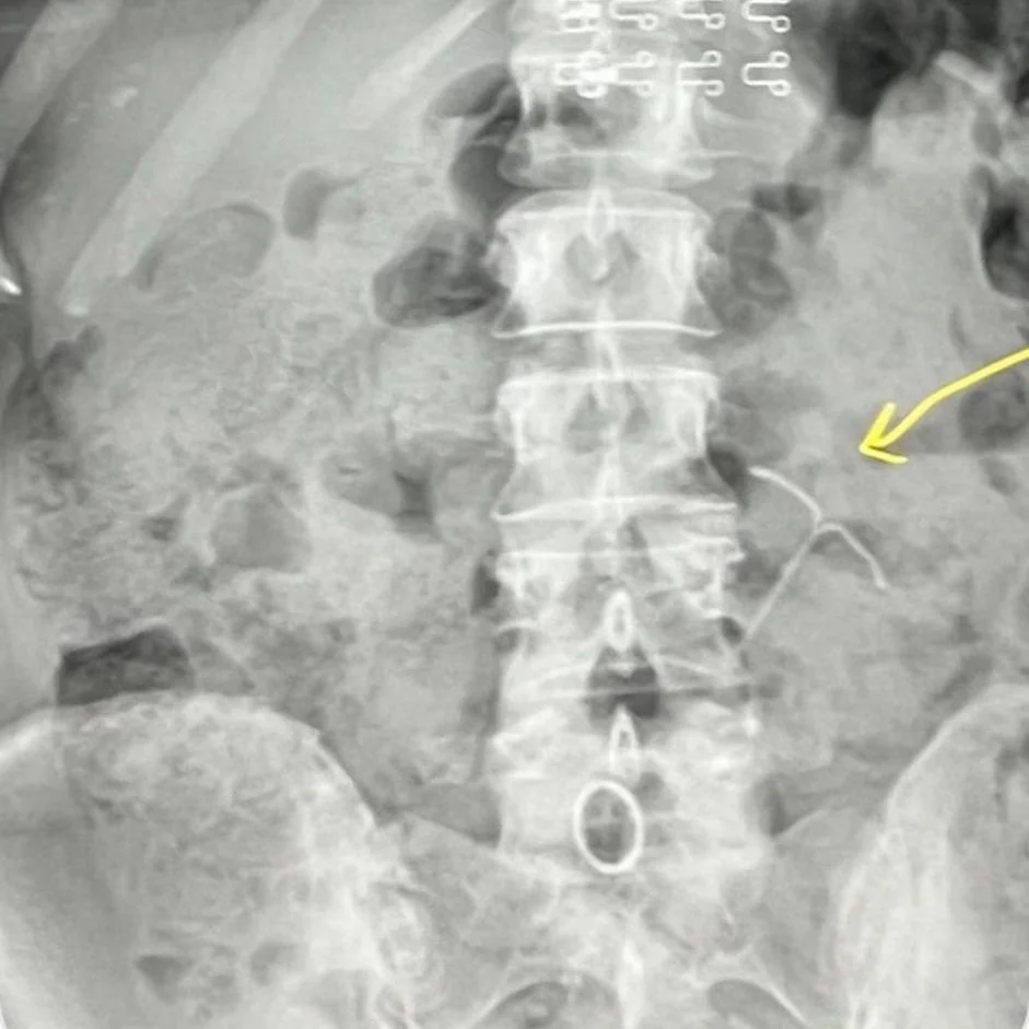 IUD Pierced My Uterus & Found Touching My Liver