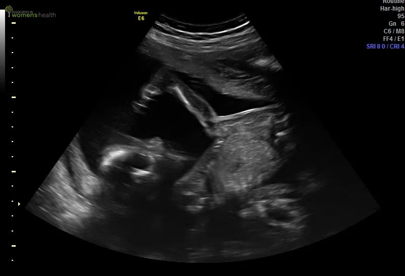 Week 20 ultrasound - Looks like we've got a yogi on our hands!