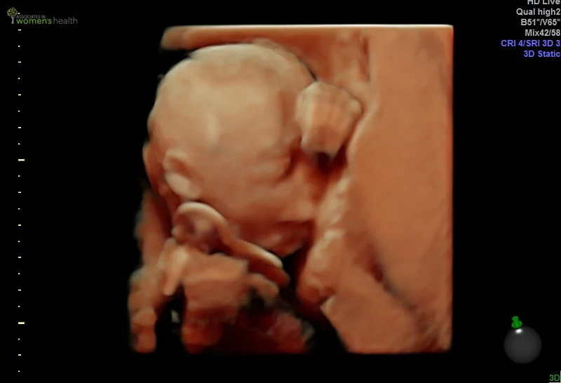 20 week 3D ultrasound