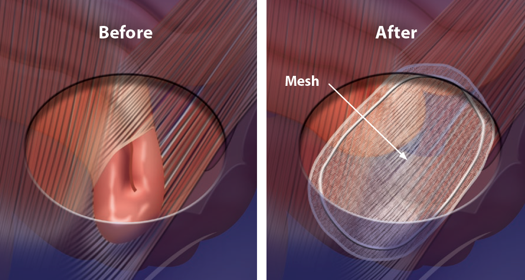 open_inguinal_hernia-e1524341433110.png