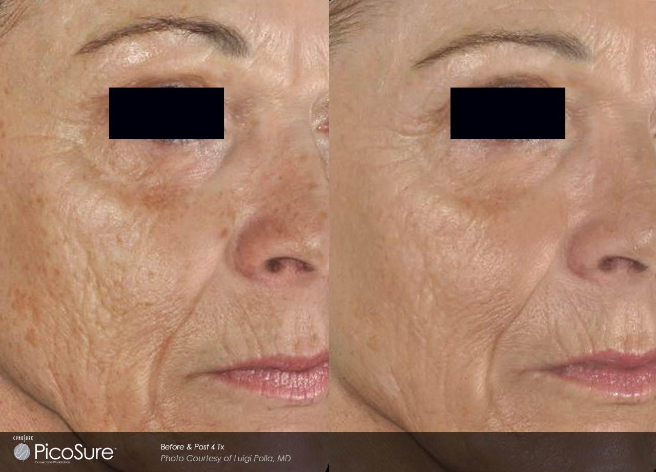 Skin Revitalization *