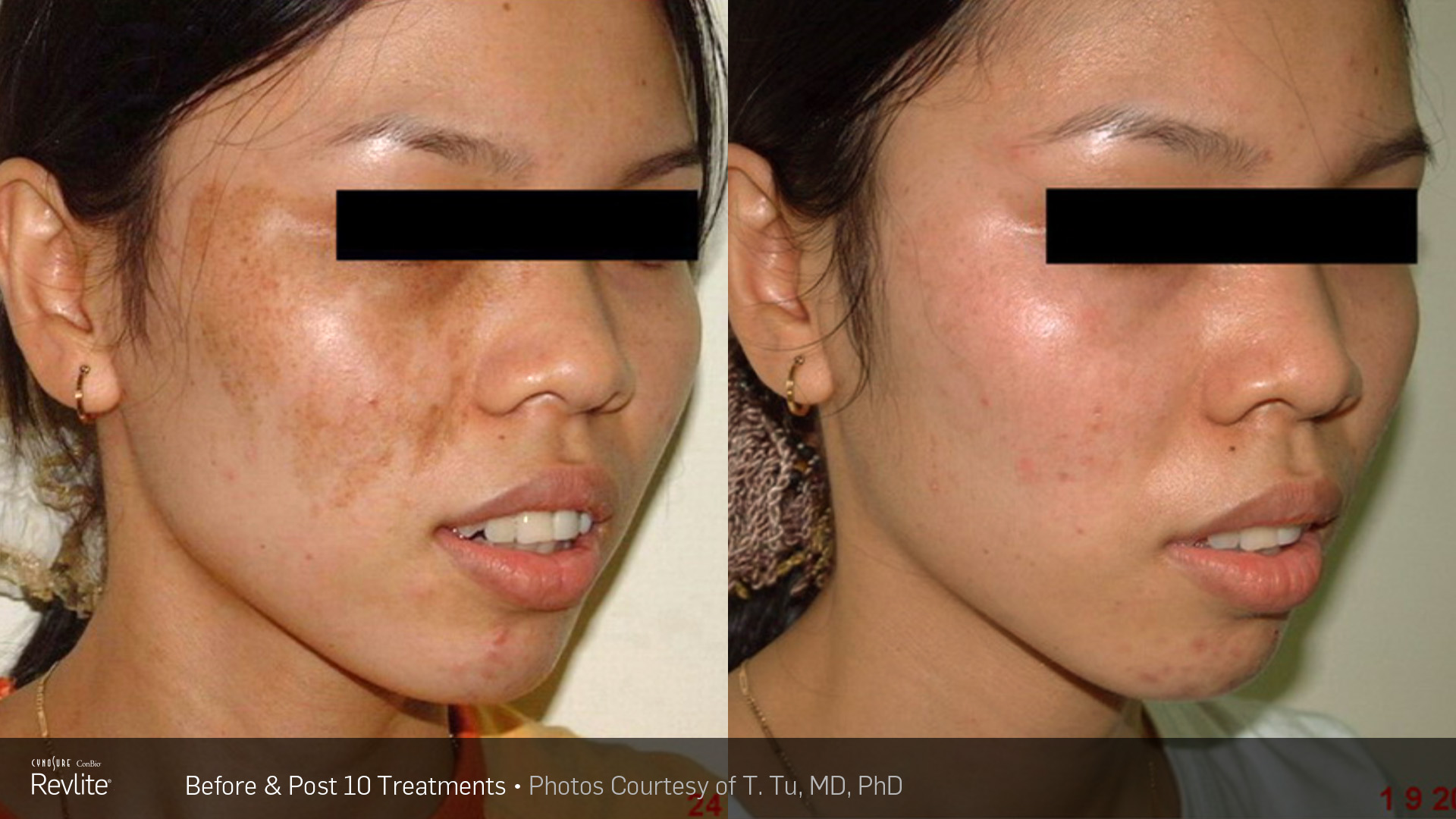Melasma *