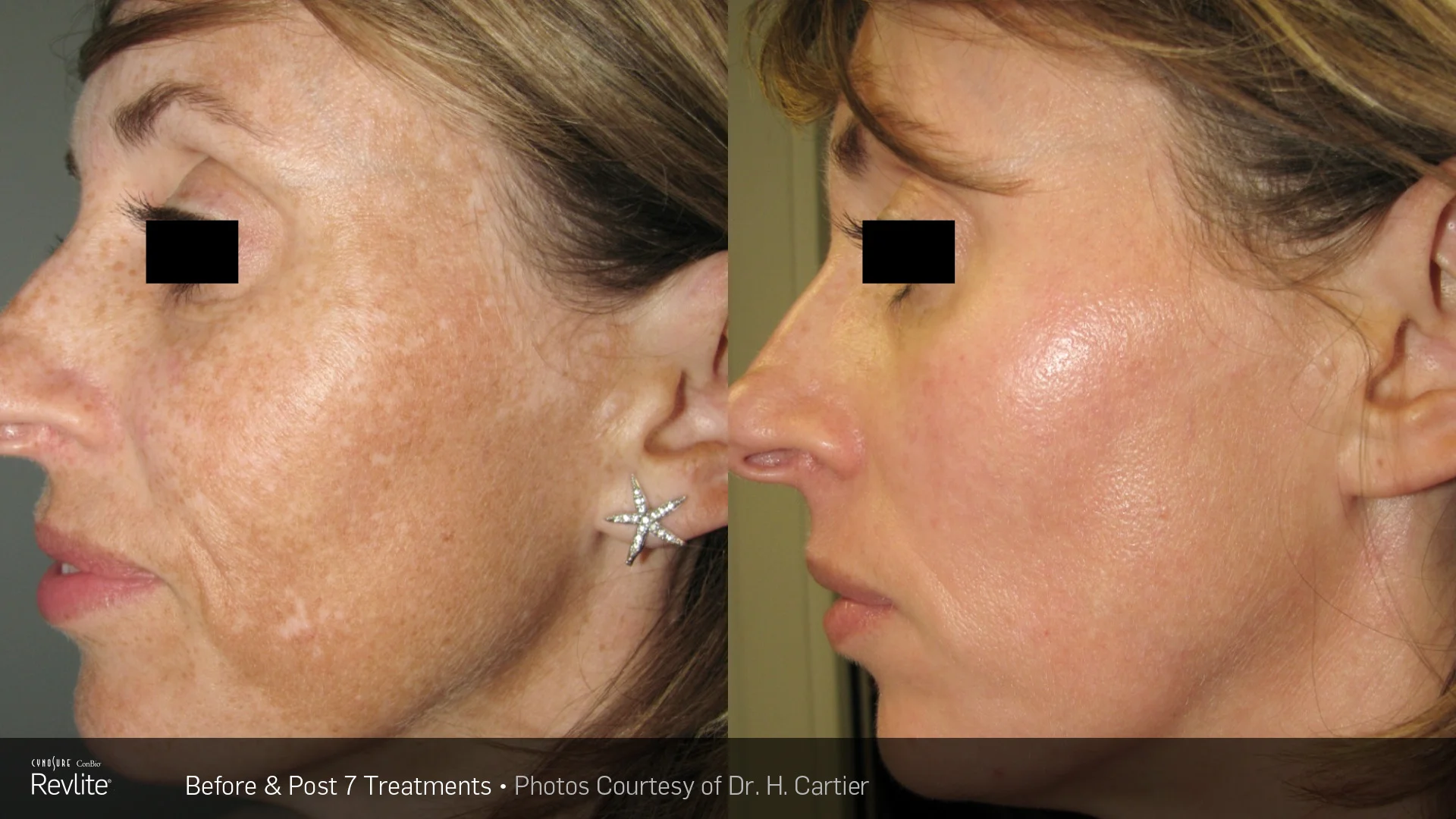 Melasma *