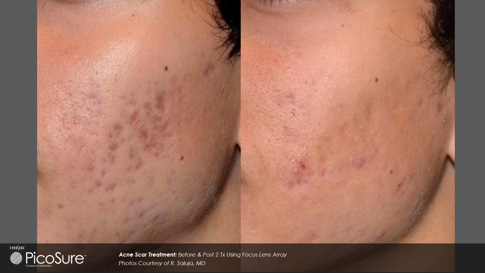 Acne Scars *