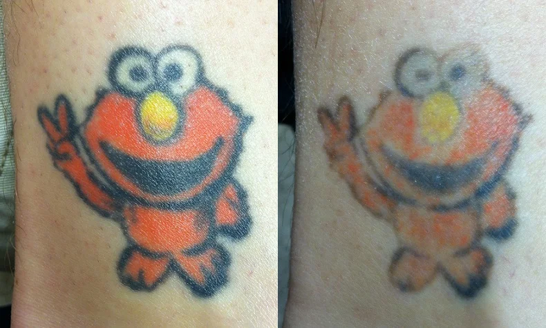 Tattoo Removal*