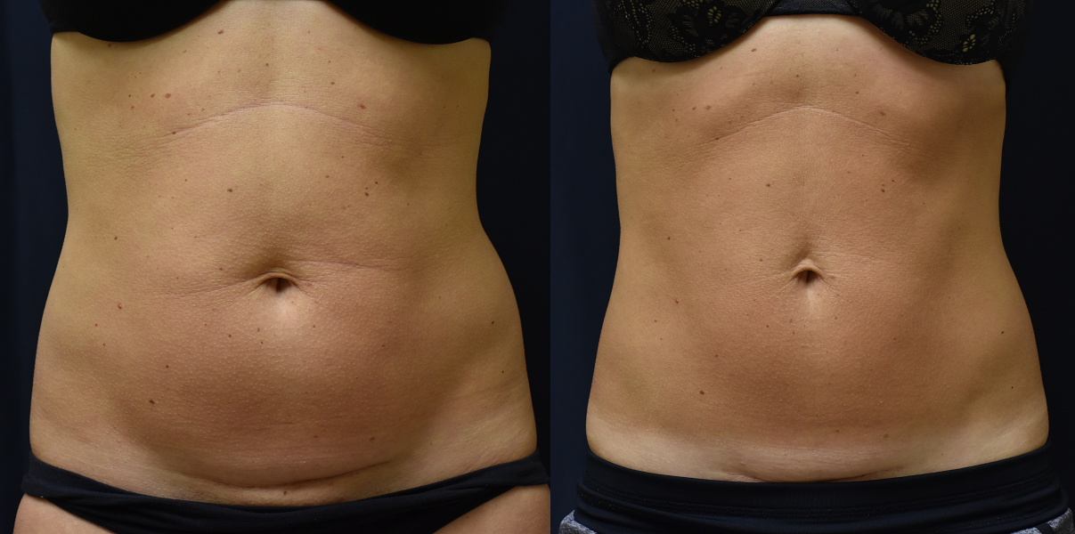 SculpSure Body Contouring*