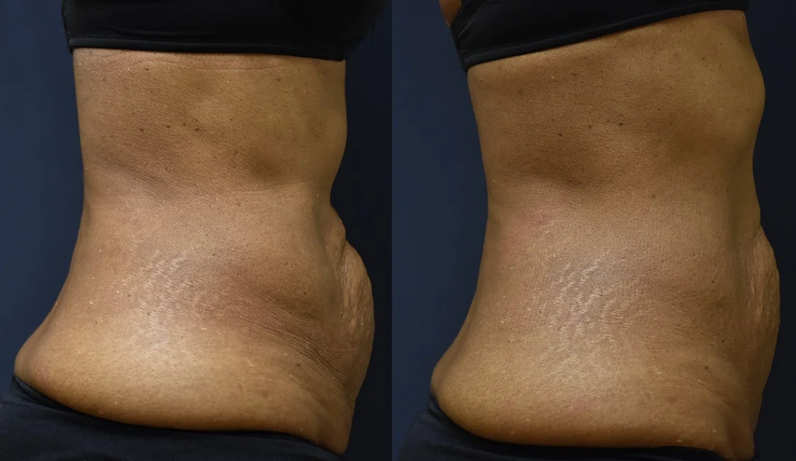 SculpSure Body Contouring*