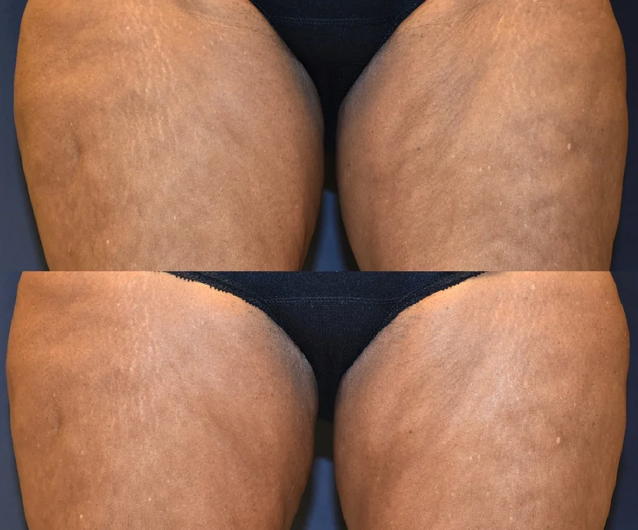 SculpSure Body Contouring*