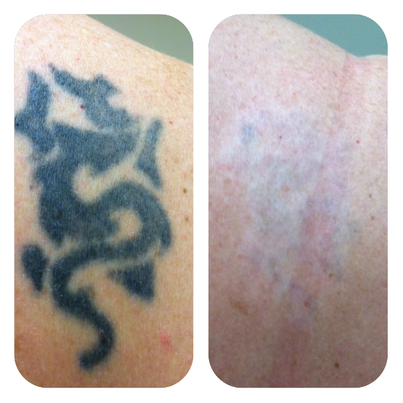Tattoo Removal *