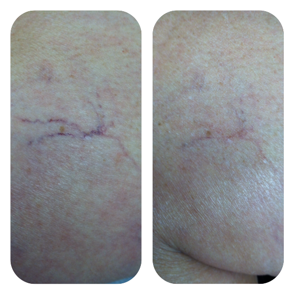 Vein treatment*