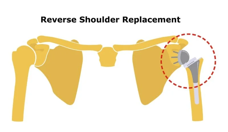 Tips For Reverse Shoulder Replacement Rehab