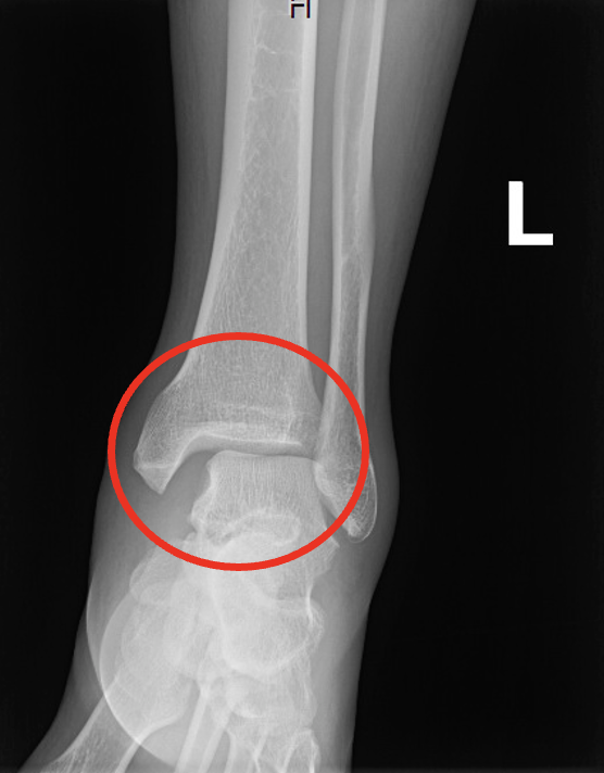 Ortho Pearls The Maisonneuve Fracture Cook County Emergency 