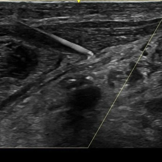 Basic Nerve Blocks