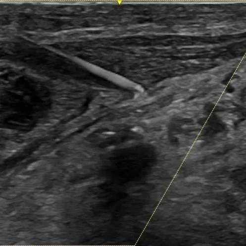Other Regional Anesthesia (Coming Soon!)