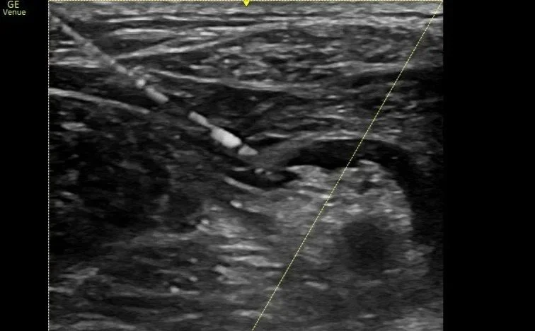 Peripheral Nerve Blocks