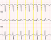 Svt Algorithm Rp Interval Heart of the Matter: SVT and the RP Interval — Cook County Emergency ...