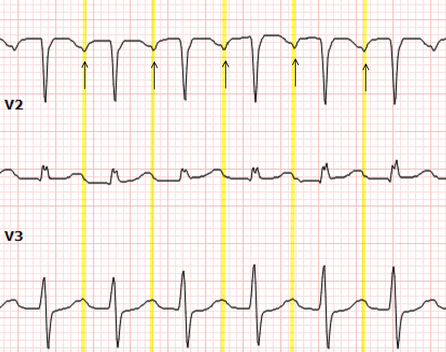 Svt In Normal R R Intervel Heart of the Matter: SVT and the RP Interval — Cook County Emergency ...