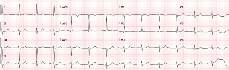 Svt In Normal R R Intervel Heart of the Matter: SVT and the RP Interval — Cook County Emergency ...