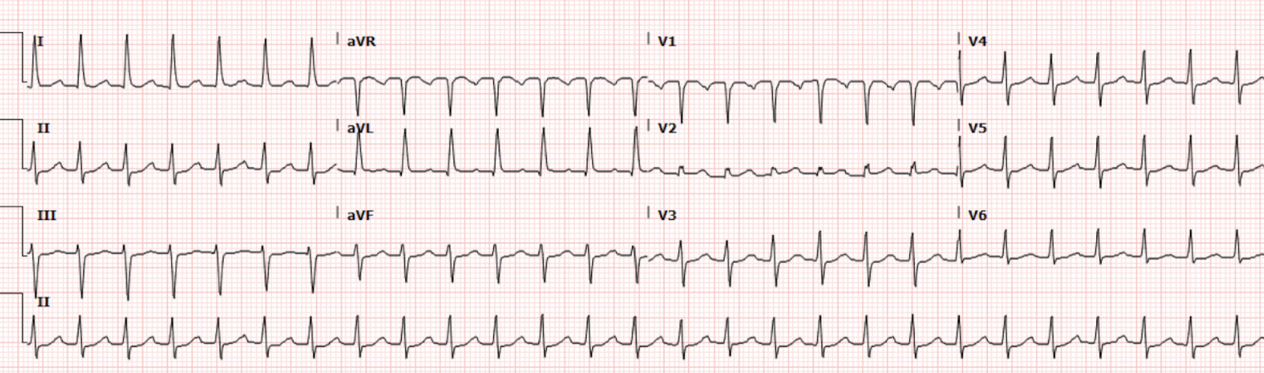Svt In Normal R R Intervel Heart of the Matter: SVT and the RP Interval — Cook County Emergency ...