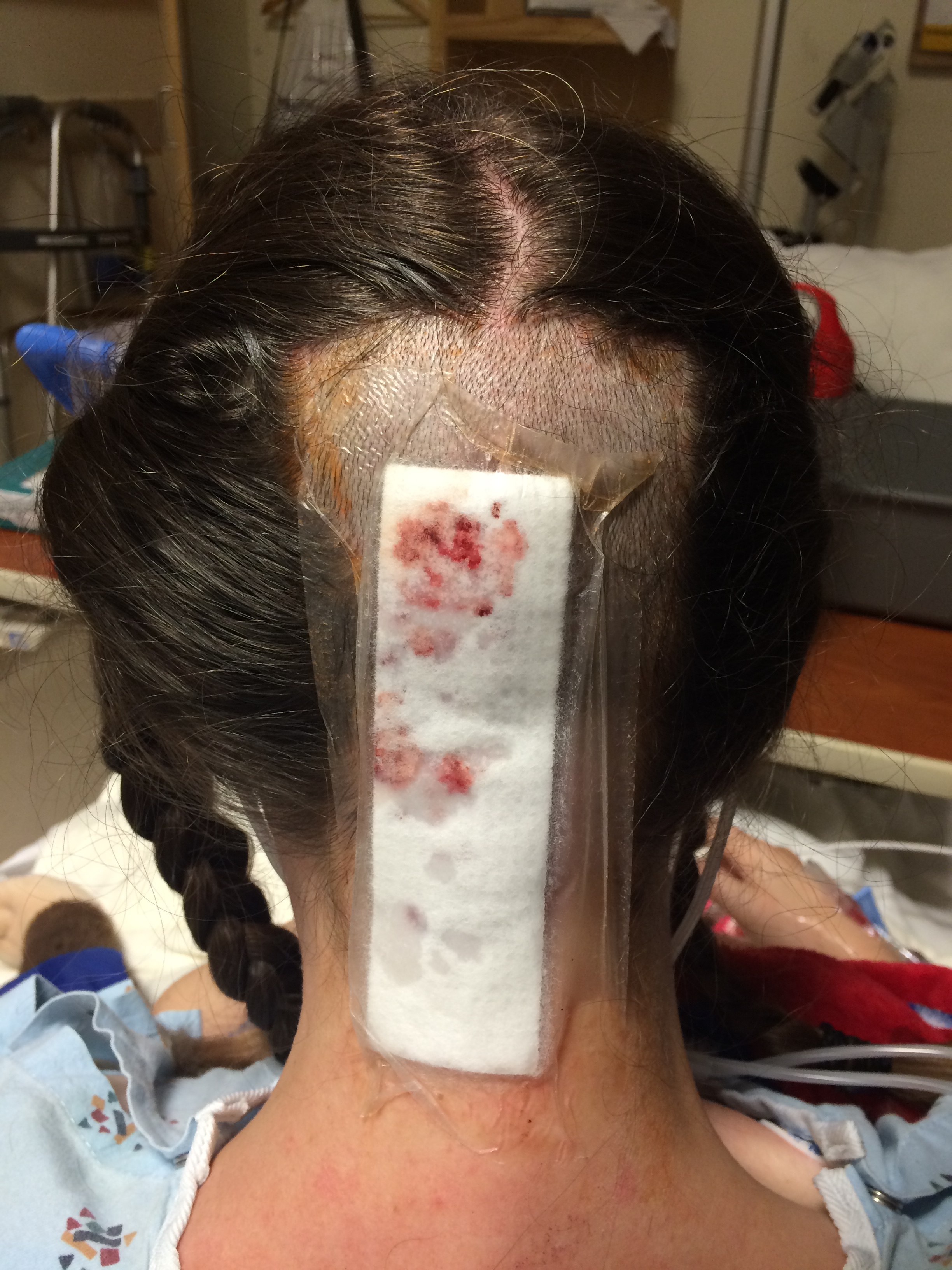 Gross! Blood! Guts! Spinal Fluid! Ick! But, worst of all, so much hair is gone! This is the day I woke up. I had to leave the bandage on for three days! It kept peeling up, because I had to ice it so often, and the edges kept getting wet. To counter-act this problem, the nurses would slap more tape right on top of the old bandage. When it was time to take the bandage off, this meant there were several layers of thick, new tape to peel off. The resident just yanked it right off, fully attached to the hair that was there. It was...unpleasant.