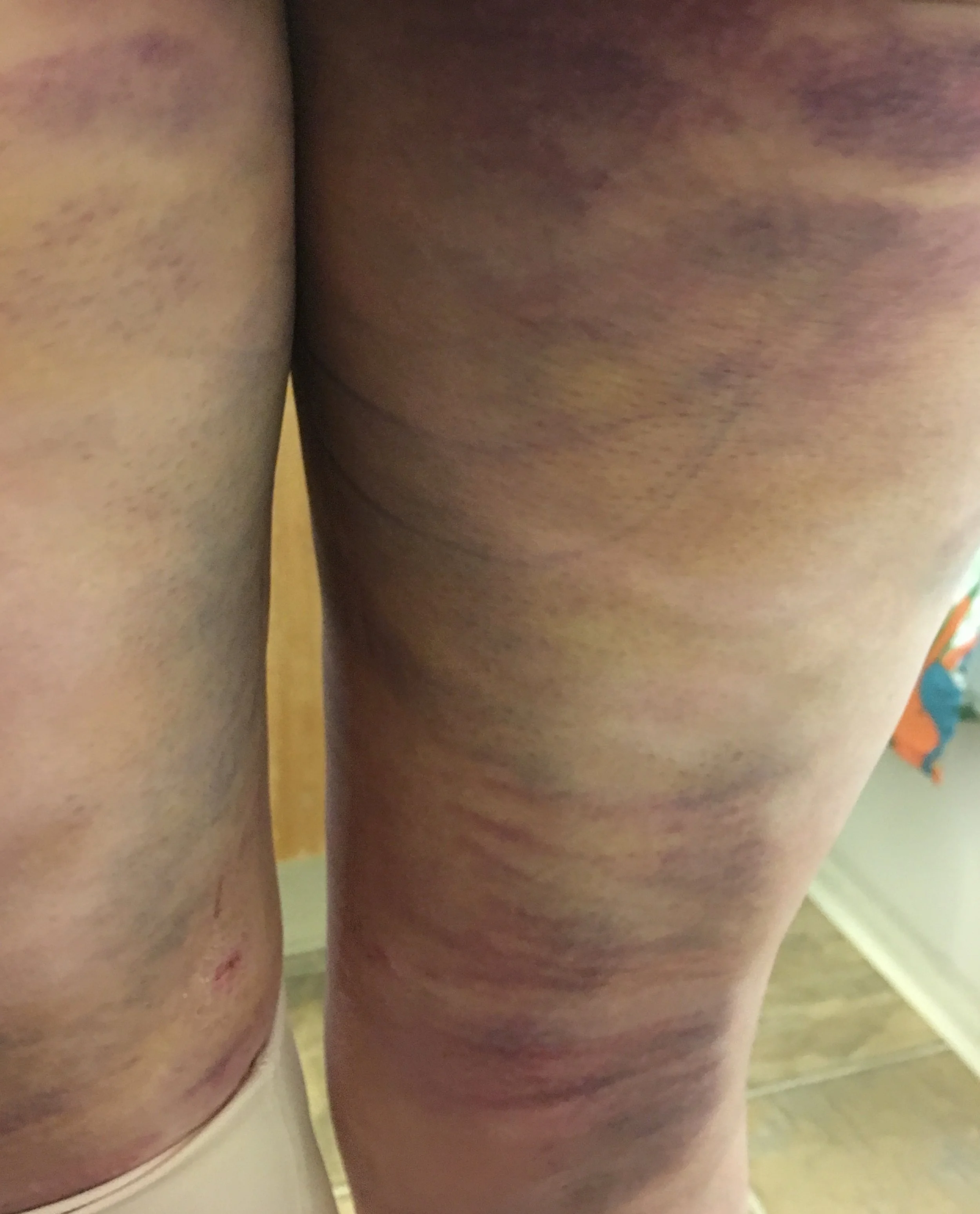 These bruises are at five days, on the back of my legs only. So, they are looking "better." There are two incisions in this picture too. So, yeah, you might be able to see why going to the bathroom is my least favorite activity at the moment. I have showered, but you can see the marker still. I wasn't exactly up for scrubbing the area with much vigor! Still really, really swollen.