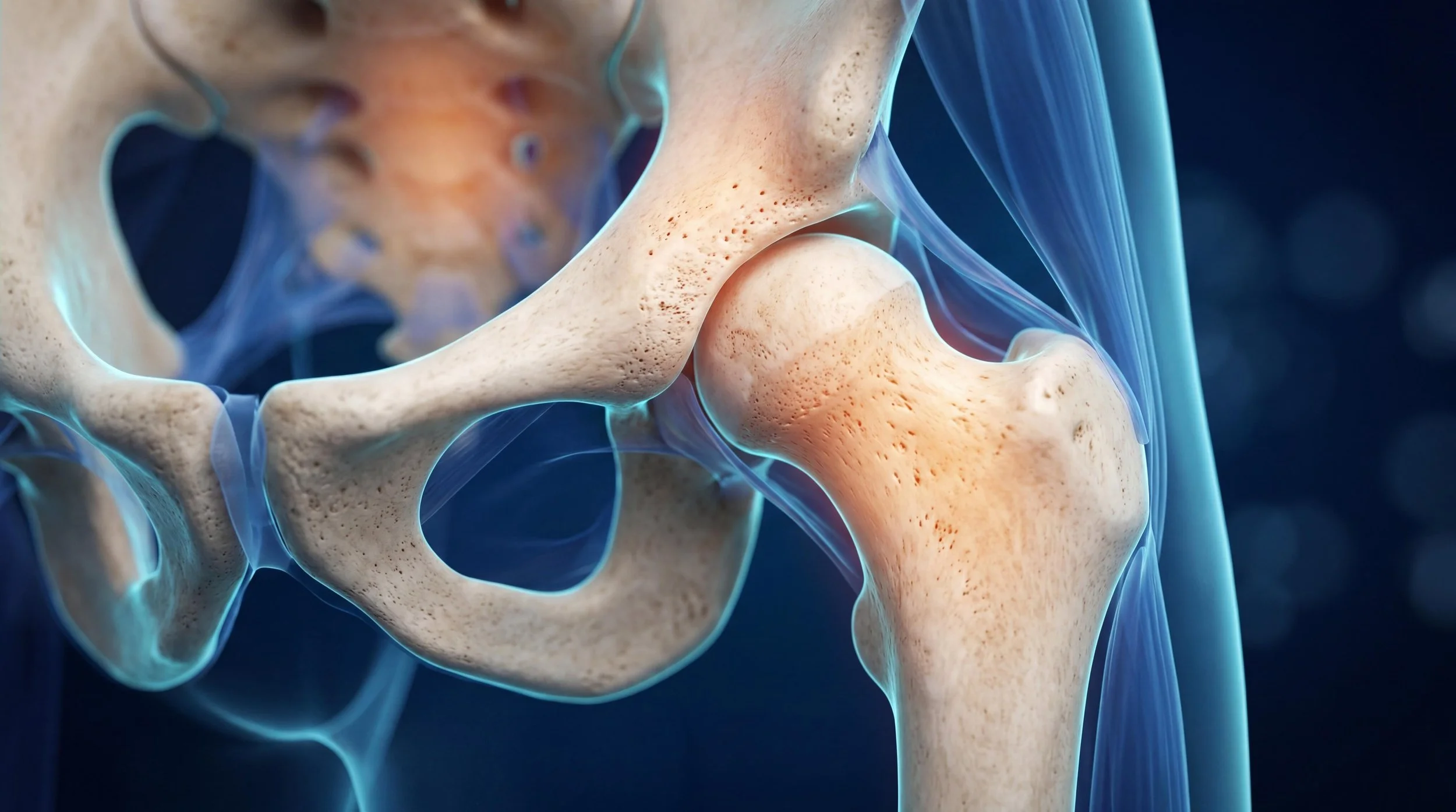 PAO Surgery — A Complete Guide for Patients with Hip Dysplasia