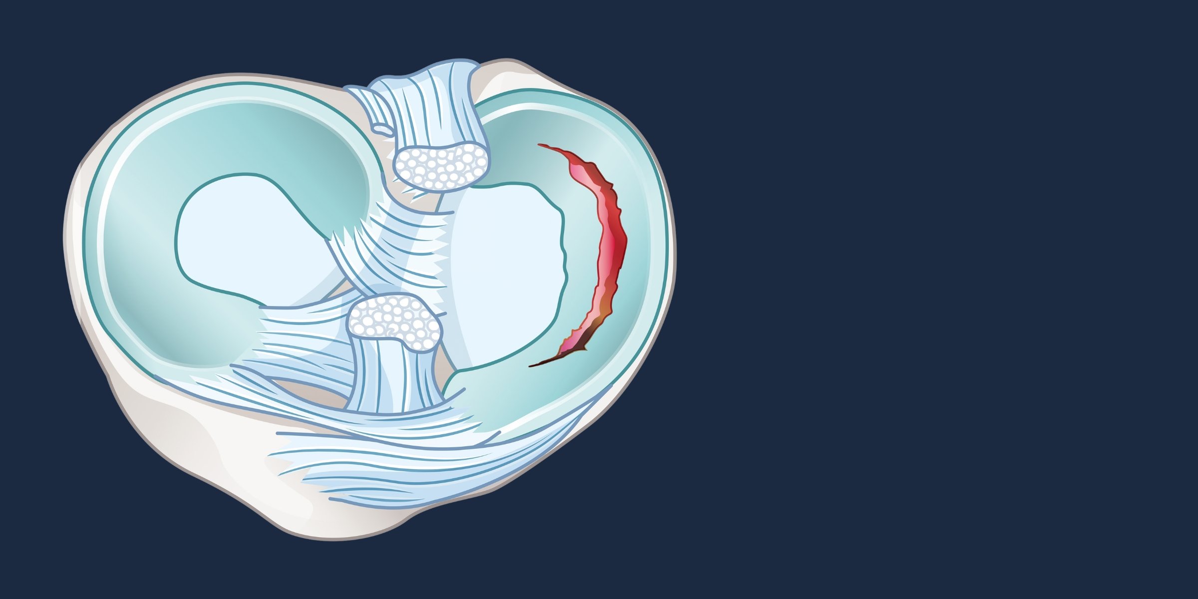 Meniscal Tears: Diagnosis and Treatment